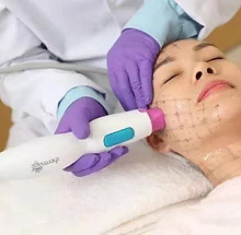 Thermage FLX Skin Tightening Treatment at Suncare Medical Clinic Irvine